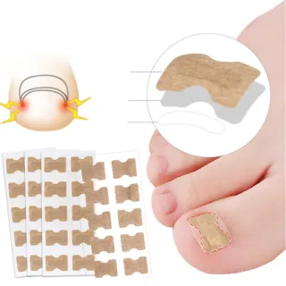 【DAYOU】24hr口los1025貳組免膠水正甲貼腳趾甲甲溝嵌甲矯正器甲貼片拉拉修指甲(大友)