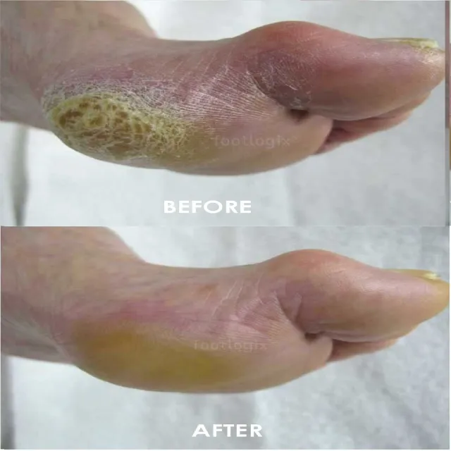 【Footlogix 芙樂其】頂級居家足繭保養雙件組