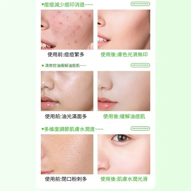 【iBloom】洛婭水楊酸果酸次拋精華液 1.5ml/支*30支-2入組(痘痘 痘印 痘坑 水楊酸 清爽控油)