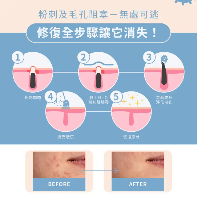 【ELLO】無暇笑容組_粉刺掰掰霜2入(MIT品牌 醫師推薦 皮膚瑕疵)