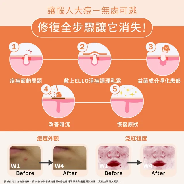【ELLO】益生菌淨痘調理乳霜 Urgent Acne Cream 18ML(益生菌 大型面皰 囊腫痘痘 乳霜)